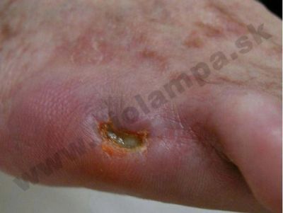 Cicatrice da amputazione in un paziente diabetico 