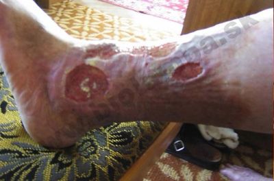 Ulcere di Bercus (ulcere dello stinco) 